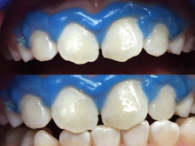 Zastosowanie icon - leczenie metodą infiltracji zębiny. Skuteczny sposób usuwania białych plam.